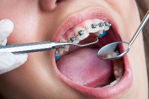Ортодонтическое лечение зубов в Уфе ortodonticheskoe-lechenie-zubov-u-vzroslyh-pacientov.jpg